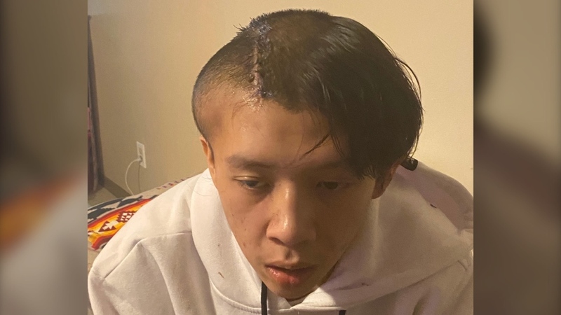 A photo of the head and shoulders of an indigenous man; one side of his head has been shaved for surgery and is extremely swollen